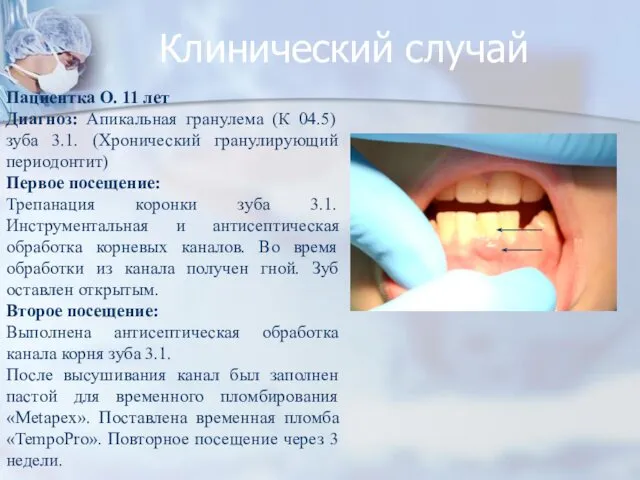 Клинический случай Пациентка О. 11 лет Диагноз: Апикальная гранулема (К 04.5)