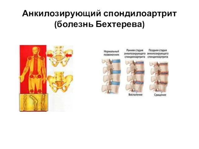 Анкилозирующий спондилоартрит (болезнь Бехтерева)