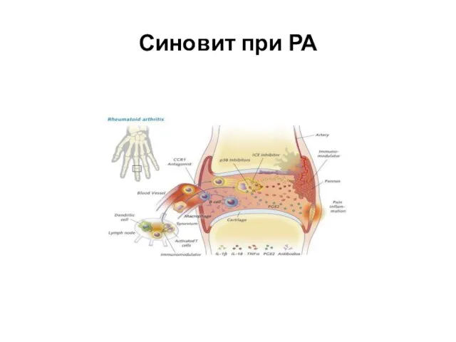 Синовит при РА