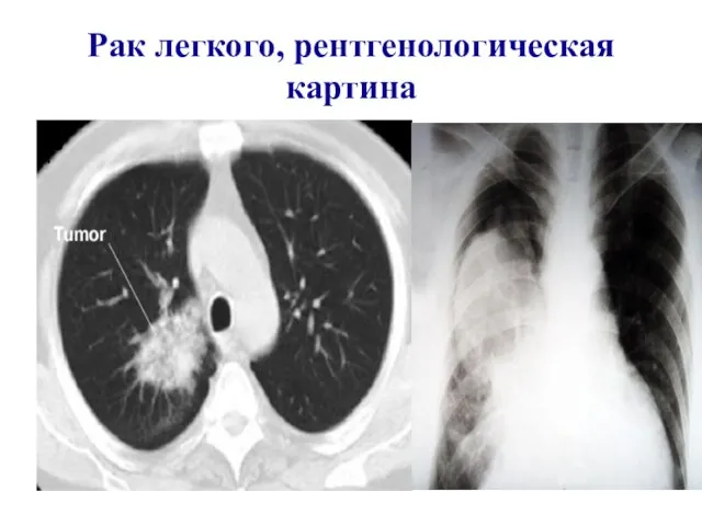 Рак легкого, рентгенологическая картина