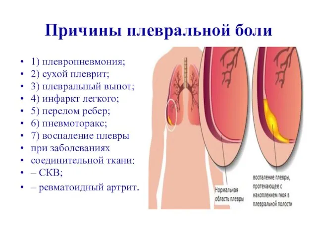 Причины плевральной боли 1) плевропневмония; 2) сухой плеврит; 3) плевральный выпот;