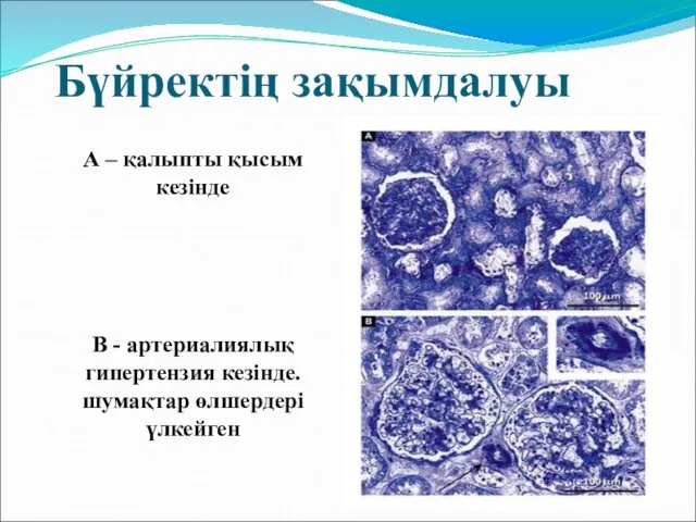 Бүйректің зақымдалуы А – қалыпты қысым кезінде В - артериалиялық гипертензия кезінде. шумақтар өлшердері үлкейген