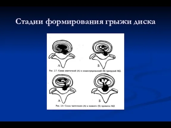 Стадии формирования грыжи диска