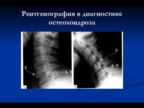 Рентгенография в диагностике остеохондроза