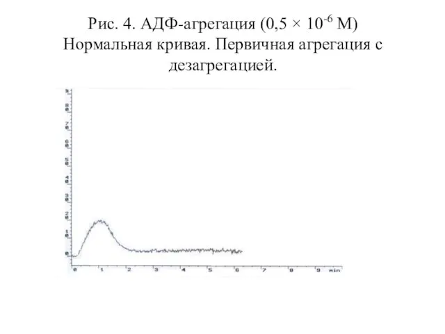 Рис. 4. АДФ-агрегация (0,5 × 10-6 М) Нормальная кривая. Первичная агрегация с дезагрегацией.