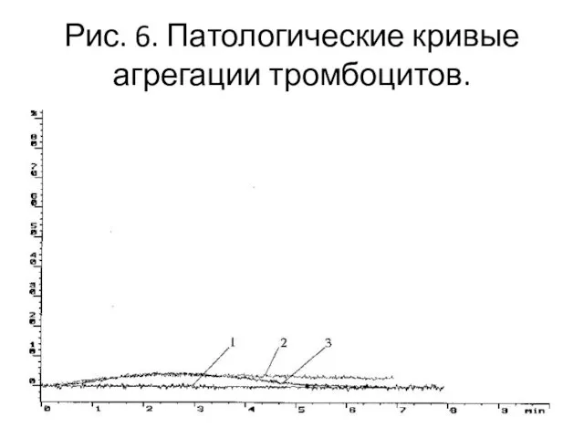 Рис. 6. Патологические кривые агрегации тромбоцитов.