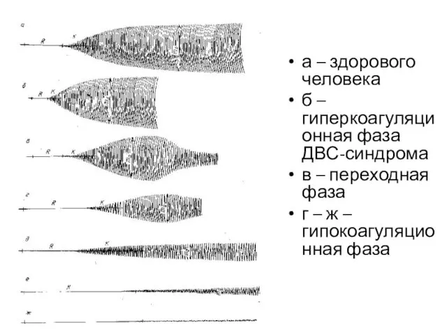 а – здорового человека б – гиперкоагуляционная фаза ДВС-синдрома в –