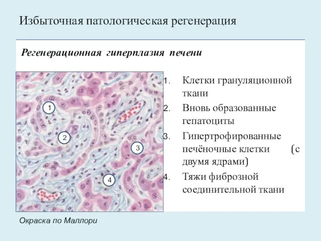 Регенерационная гиперплазия печени Клетки грануляционной ткани Вновь образованные гепатоциты Гипертрофированные печёночные