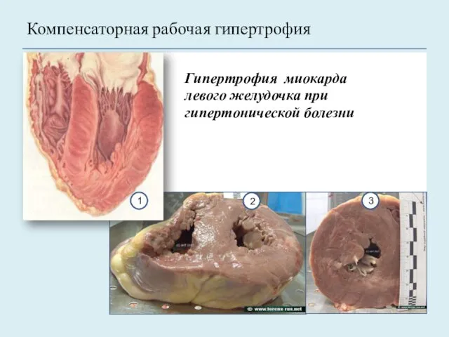 Гипертрофия миокарда левого желудочка при гипертонической болезни Компенсаторная рабочая гипертрофия 3 1 2