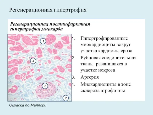 Гипертрофированные миокардиоциты вокруг участка кардиосклероза Рубцовая соединительная ткань, развившаяся в участке