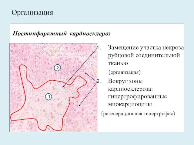 Замещение участка некроза рубцовой соединительной тканью (организация) Вокруг зоны кардиосклероза: гипертрофированные