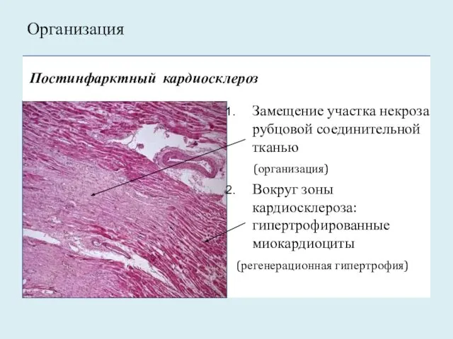 Замещение участка некроза рубцовой соединительной тканью (организация) Вокруг зоны кардиосклероза: гипертрофированные