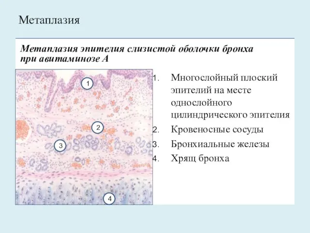 Метаплазия эпителия слизистой оболочки бронха при авитаминозе А Многослойный плоский эпителий