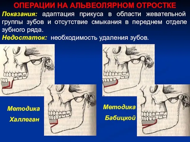 ОПЕРАЦИИ НА АЛЬВЕОЛЯРНОМ ОТРОСТКЕ Показания: адаптация прикуса в области жевательной группы