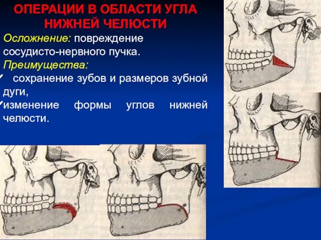 ОПЕРАЦИИ В ОБЛАСТИ УГЛА НИЖНЕЙ ЧЕЛЮСТИ Осложнение: повреждение сосудисто-нервного пучка. Преимущества: