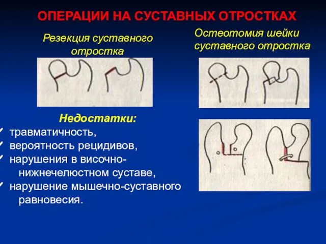 Резекция суставного отростка Недостатки: травматичность, вероятность рецидивов, нарушения в височно- нижнечелюстном