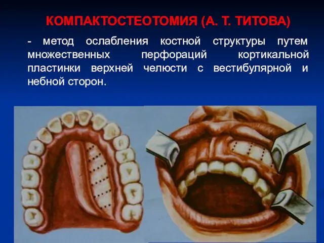 КОМПАКТОСТЕОТОМИЯ (А. Т. ТИТОВА) - метод ослабления костной структуры путем множественных