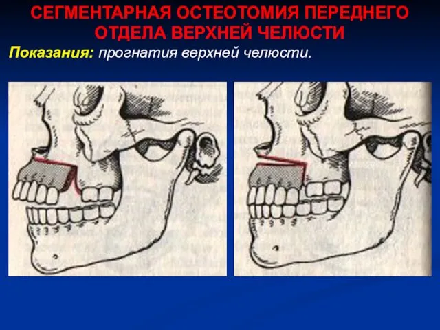 СЕГМЕНТАРНАЯ ОСТЕОТОМИЯ ПЕРЕДНЕГО ОТДЕЛА ВЕРХНЕЙ ЧЕЛЮСТИ Показания: прогнатия верхней челюсти.