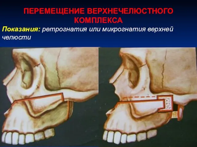 ПЕРЕМЕЩЕНИЕ ВЕРХНЕЧЕЛЮСТНОГО КОМПЛЕКСА Показания: ретрогнатия или микрогнатия верхней челюсти