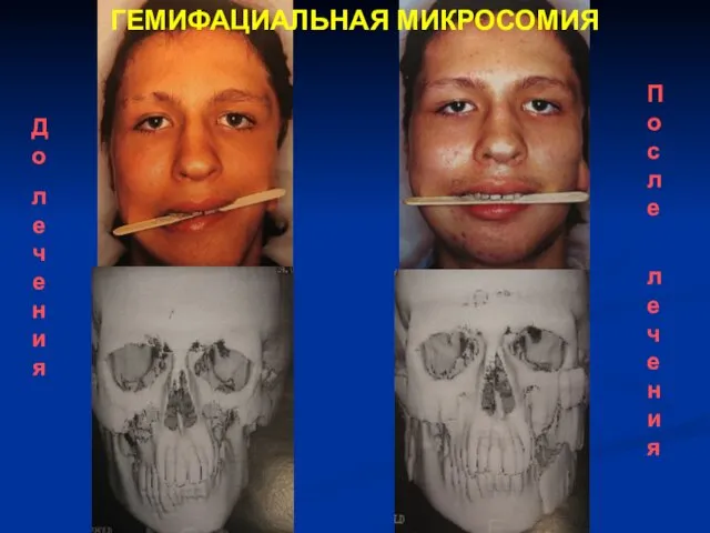 ГЕМИФАЦИАЛЬНАЯ МИКРОСОМИЯ До лечения После лечения