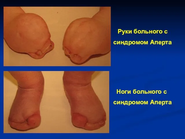 Руки больного с синдромом Аперта Ноги больного с синдромом Аперта