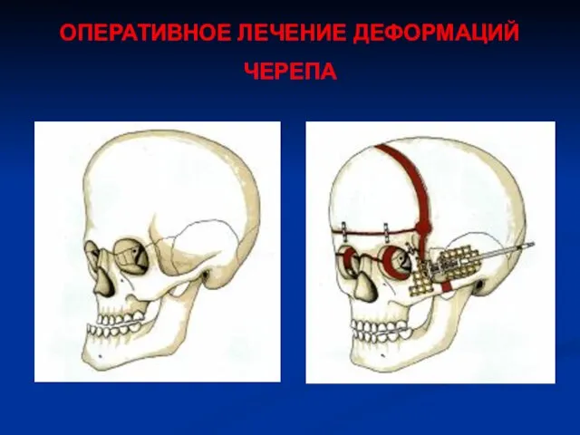 ОПЕРАТИВНОЕ ЛЕЧЕНИЕ ДЕФОРМАЦИЙ ЧЕРЕПА