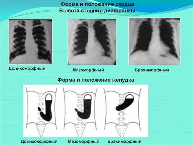 Долихоморфный Мезоморфный Брахиморфный Форма и положение сердца Высота стояния диафрагмы Форма