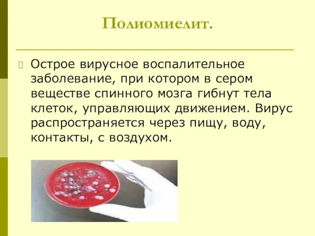 Полиомиелит. Острое вирусное воспалительное заболевание, при котором в сером веществе спинного