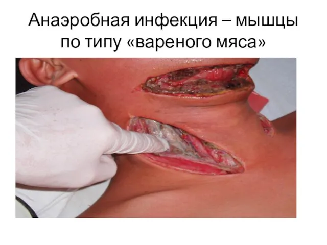 Анаэробная инфекция – мышцы по типу «вареного мяса»