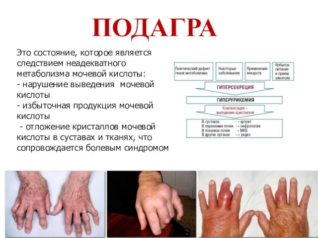 ПОДАГРА Это состояние, которое является следствием неадекватного метаболизма мочевой кислоты: -