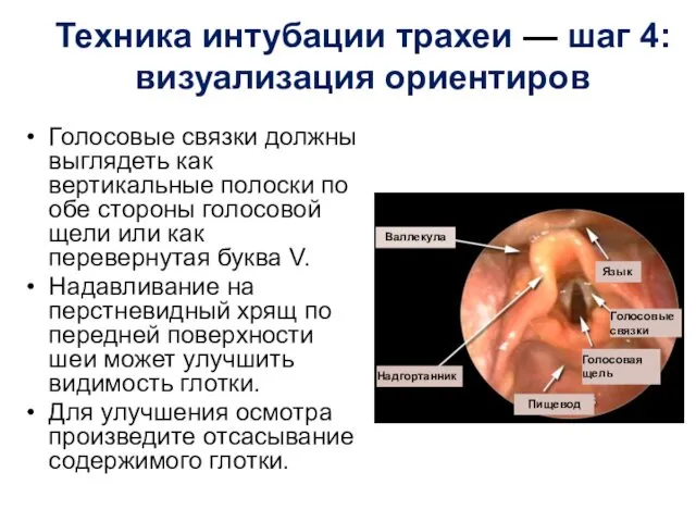Техника интубации трахеи — шаг 4: визуализация ориентиров Голосовые связки должны