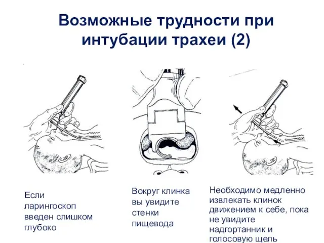 Возможные трудности при интубации трахеи (2) Если ларингоскоп введен слишком глубоко