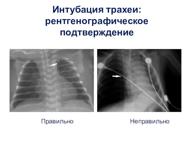 Интубация трахеи: рентгенографическое подтверждение Правильно Неправильно