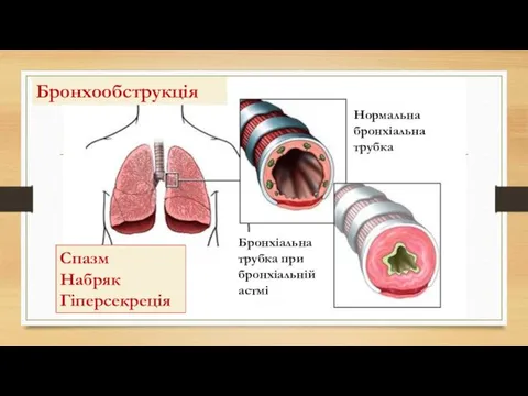 Нормальна бронхіальна трубка Бронхіальна трубка при бронхіальній астмі Спазм Набряк Гіперсекреція Бронхообструкція