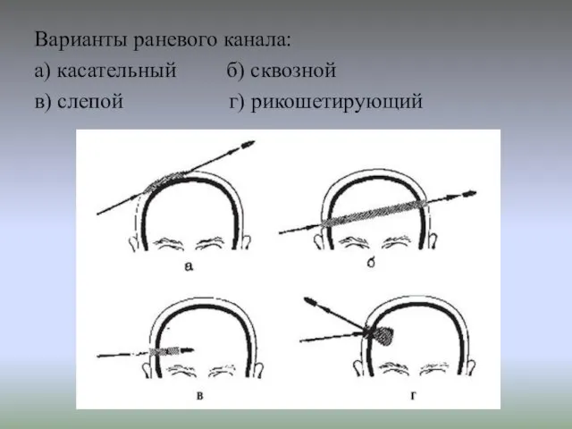 Варианты раневого канала: а) касательный б) сквозной в) слепой г) рикошетирующий