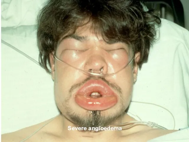 Severe angioedema