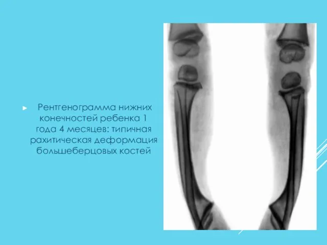 Рентгенограмма нижних конечностей ребенка 1 года 4 месяцев: типичная рахитическая деформация большеберцовых костей