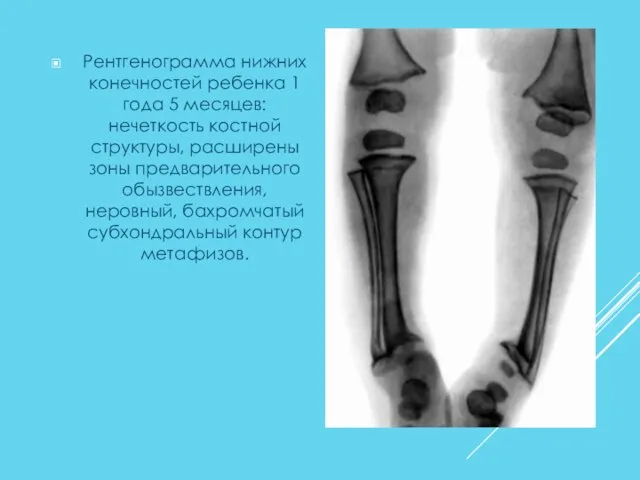 Рентгенограмма нижних конечностей ребенка 1 года 5 месяцев: нечеткость костной структуры,