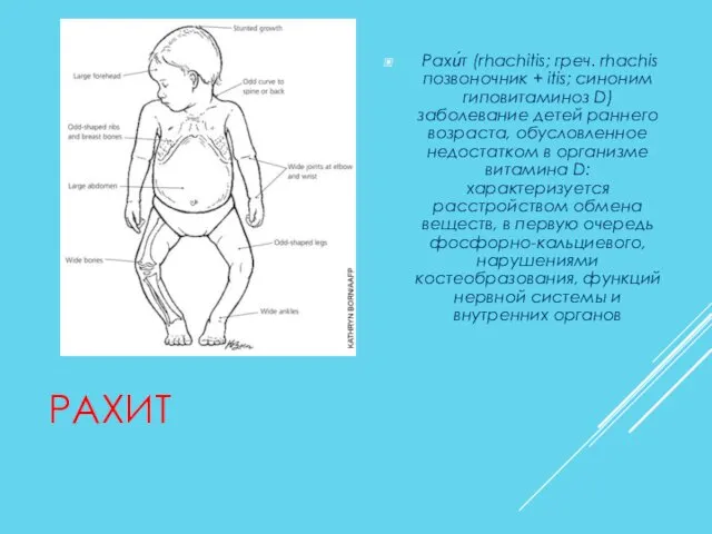 РАХИТ Рахи́т (rhachitis; греч. rhachis позвоночник + itis; синоним гиповитаминоз D)