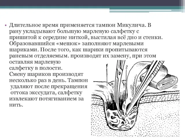 Длительное время применяется тампон Микулича. В рану укладывают большую марлевую салфетку