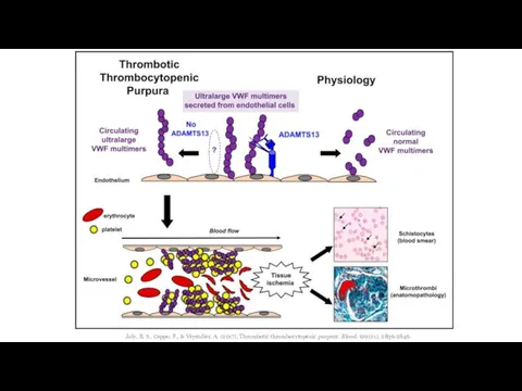 Joly, B. S., Coppo, P., & Veyradier, A. (2017). Thrombotic thrombocytopenic purpura. Blood, 129(21), 2836-2846.