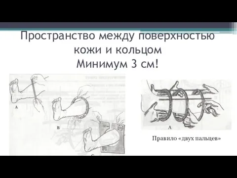 Пространство между поверхностью кожи и кольцом Минимум 3 см! Правило «двух пальцев»