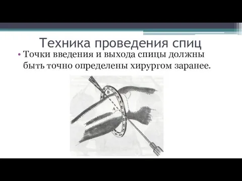 Техника проведения спиц Точки введения и выхода спицы должны быть точно определены хирургом заранее.