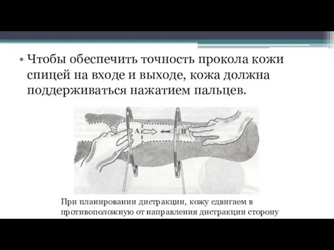 Чтобы обеспечить точность прокола кожи спицей на входе и выходе, кожа