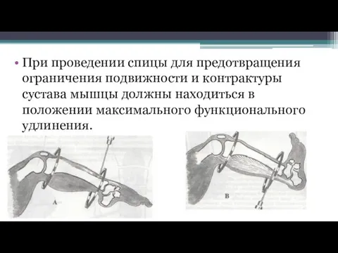 При проведении спицы для предотвращения ограничения подвижности и контрактуры сустава мышцы