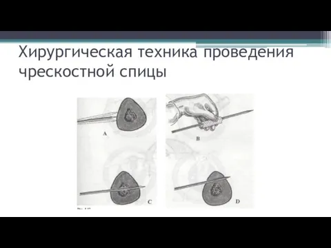 Хирургическая техника проведения чрескостной спицы