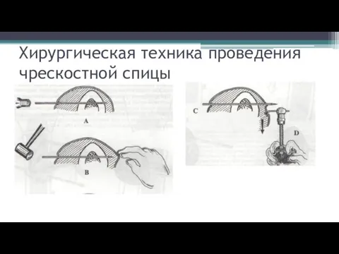 Хирургическая техника проведения чрескостной спицы