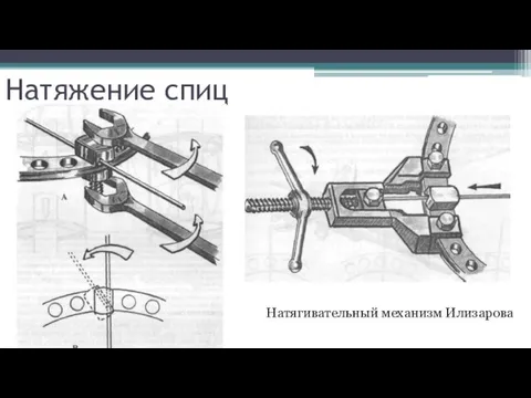 Натяжение спиц Натягивательный механизм Илизарова