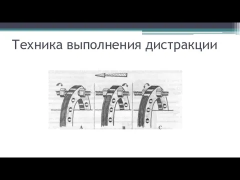 Техника выполнения дистракции