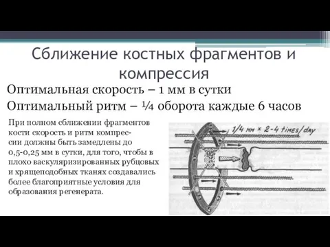 Сближение костных фрагментов и компрессия Оптимальная скорость – 1 мм в